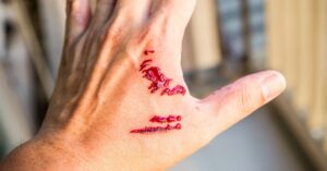 Where do Wenatchee Dog Bite Accidents and Animal Attacks Happen Most?