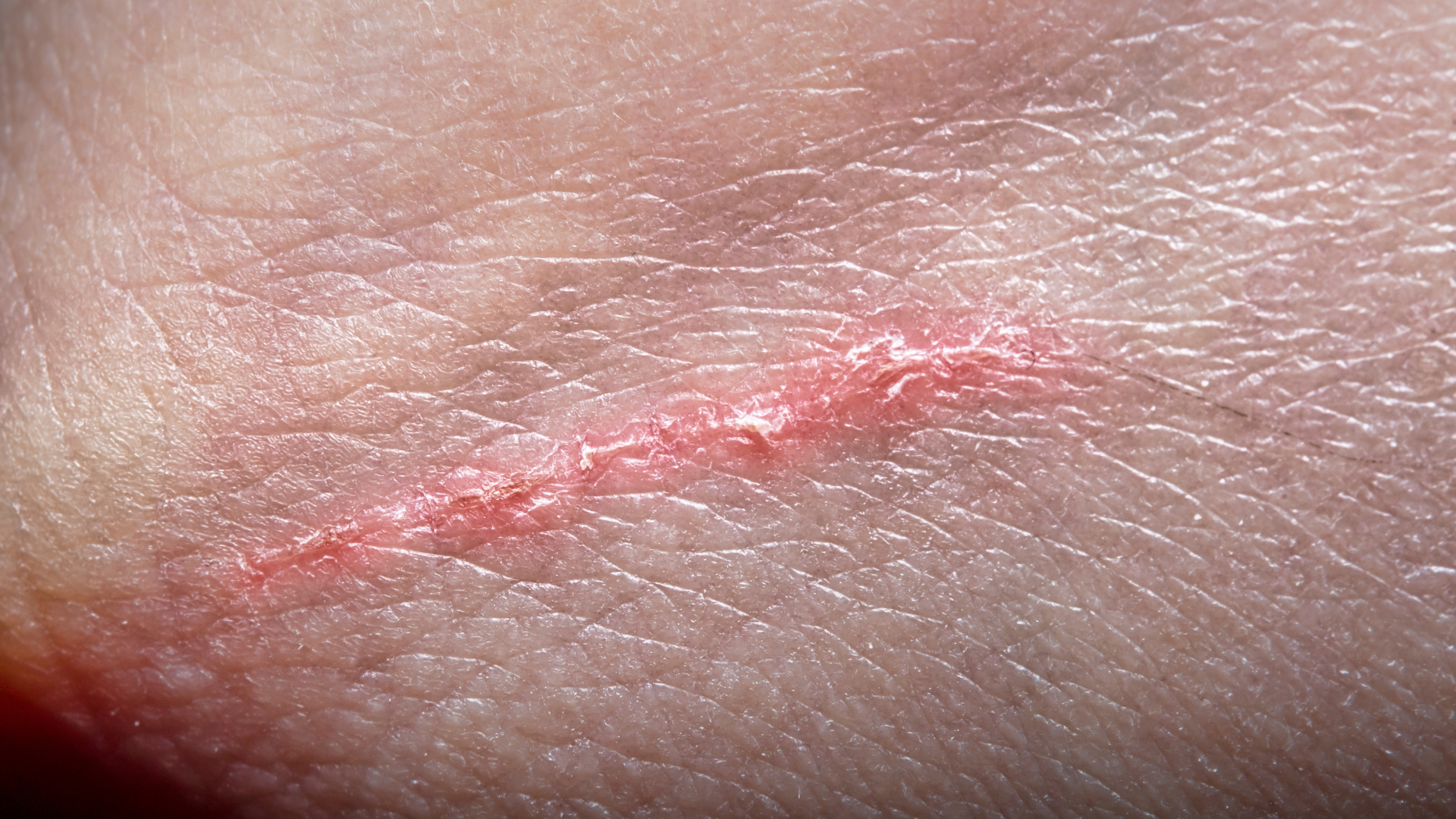 Puyallup Boy Recovering After Dog Bite Accident Left Him Needing Stitches